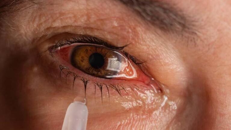 Kendini göz kapaklarında kızarıklık ve şişlik ile gösterir!