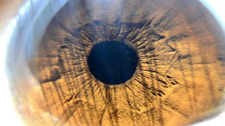 Yeni trend göz rengi değiştirme ameliyatı