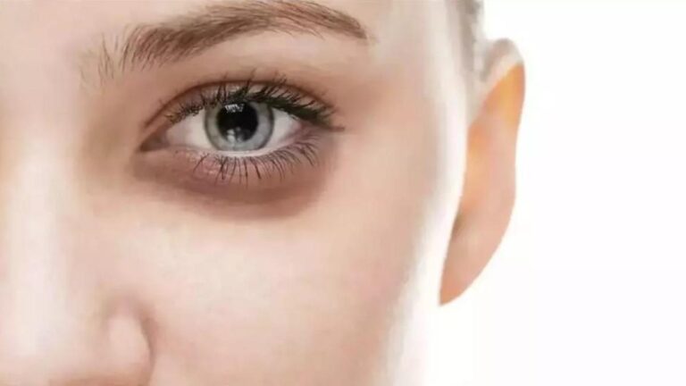 GÖZ ÇEVRESİNDE YAŞLANMAYI ÖNLEMEK İÇİN NELER YAPILABİLİR?