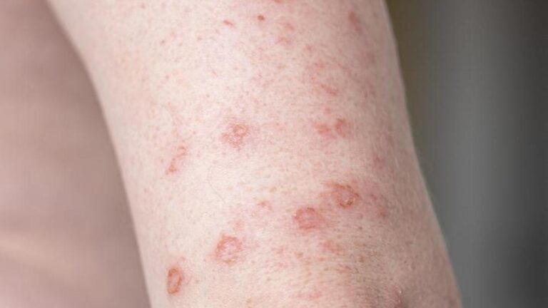 Sifiliz belirtileri nelerdir? Sifiliz nasıl anlanır? Tedavi yöntemleri nelerdir?